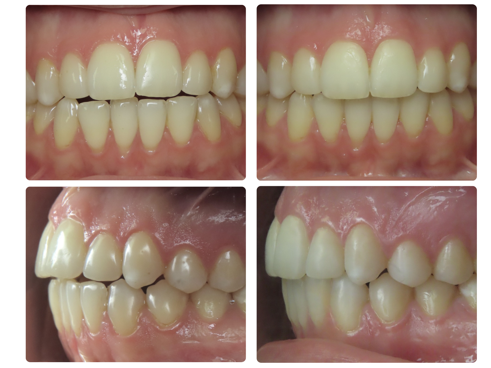 Antes y después de caso Clase II y protrusión dental superior
