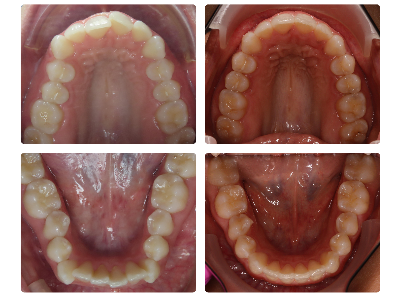 Antes y después de espacios y mordida borde a borde anterior